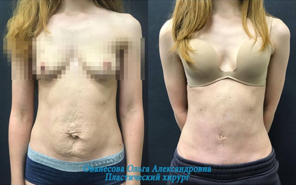 Пациентка доктора Ованесовой до и после абдоминопластики