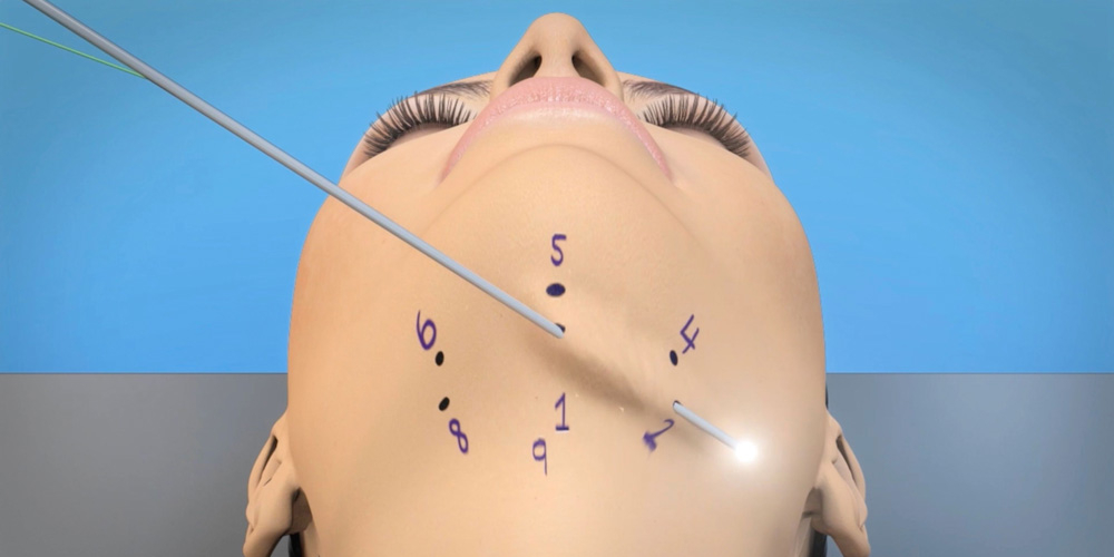 Процедура MyEllevate