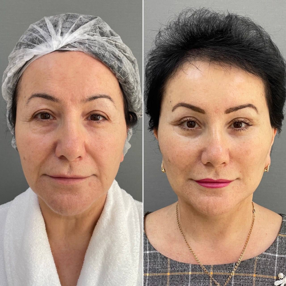 Пациентка пластического хирурга Марины Четвериковой до и после комплексного омоложения.
