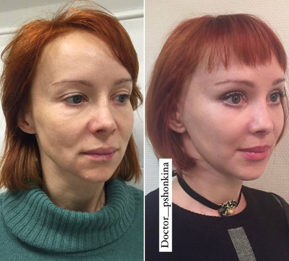 ринопластика Пшонкина