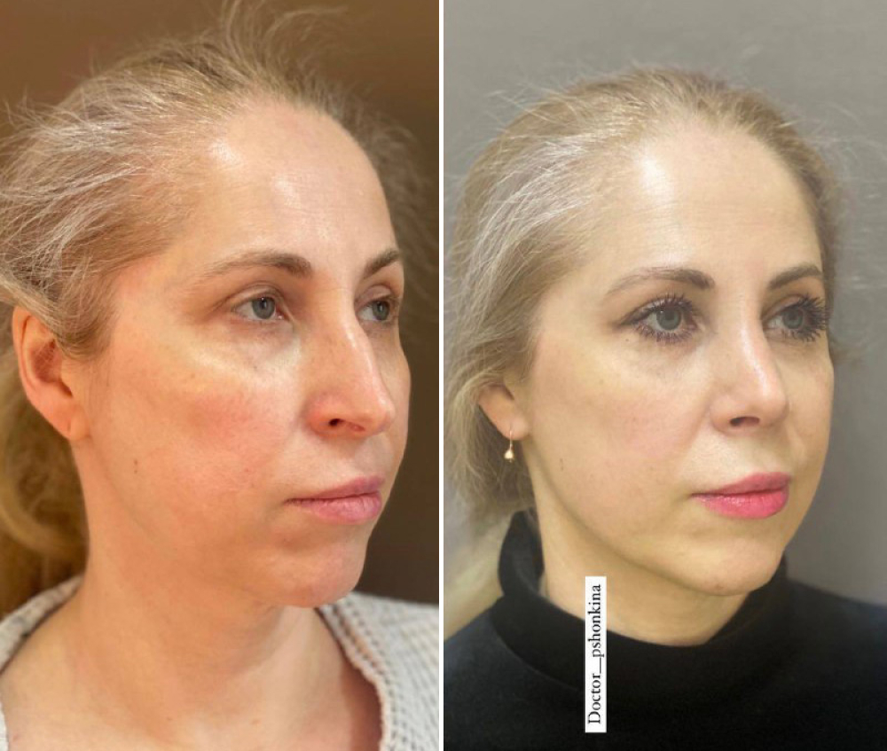 ринопластика Светлана Пшонкина