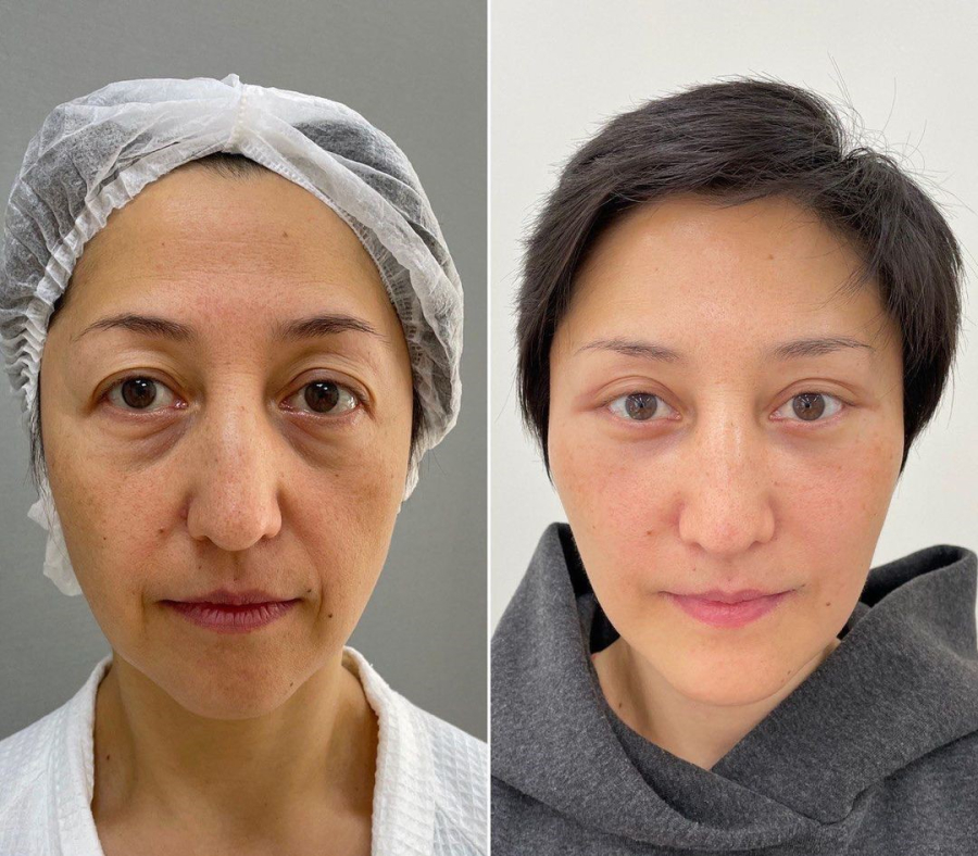 Пациентка пластического хирурга Марины Четвериковой до и после комплексного омоложения лица