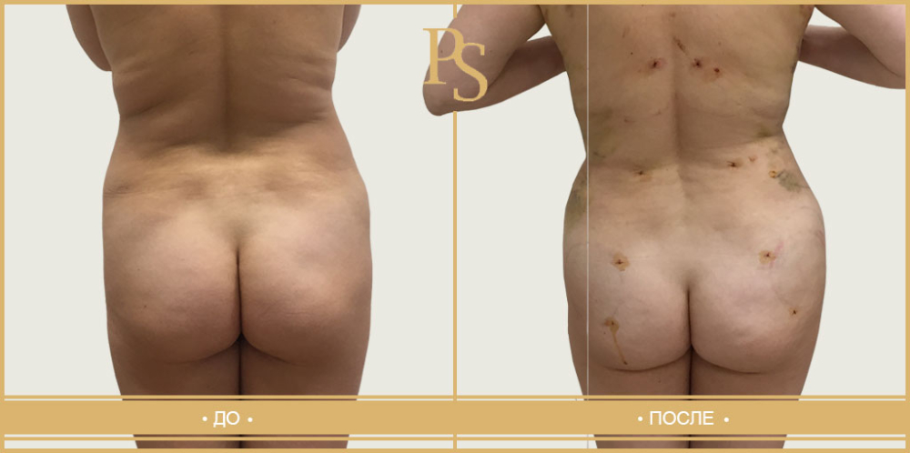 Пациентка пластического хирурга Светланы Пшонкиной до и после липосакции тела