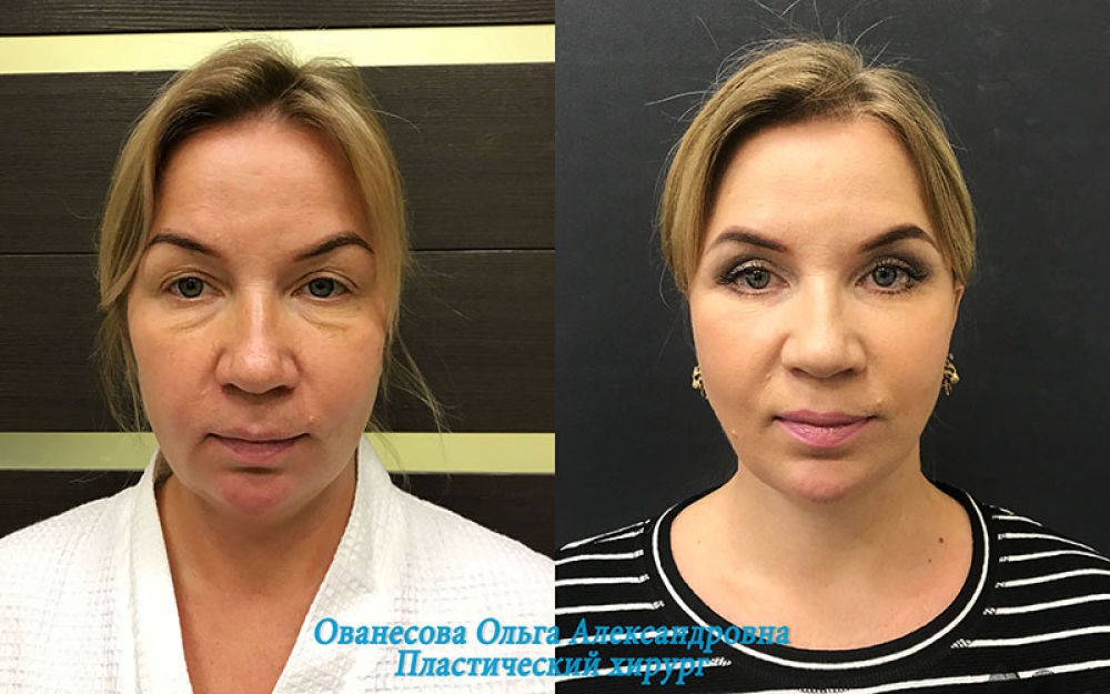 Пациентка пластического хирурга Ольги Ованесовой до и после комплексного омоложения