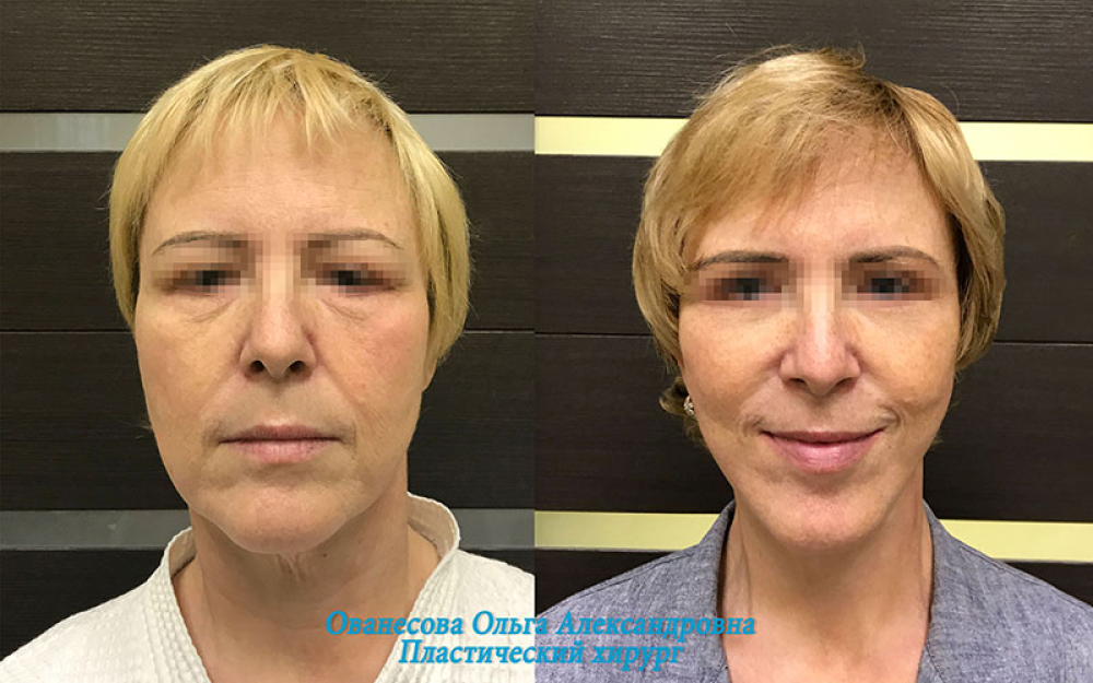 Пациентка доктора Ольги Ованесовой. Выполнен комплекс омоложения лица и шеи