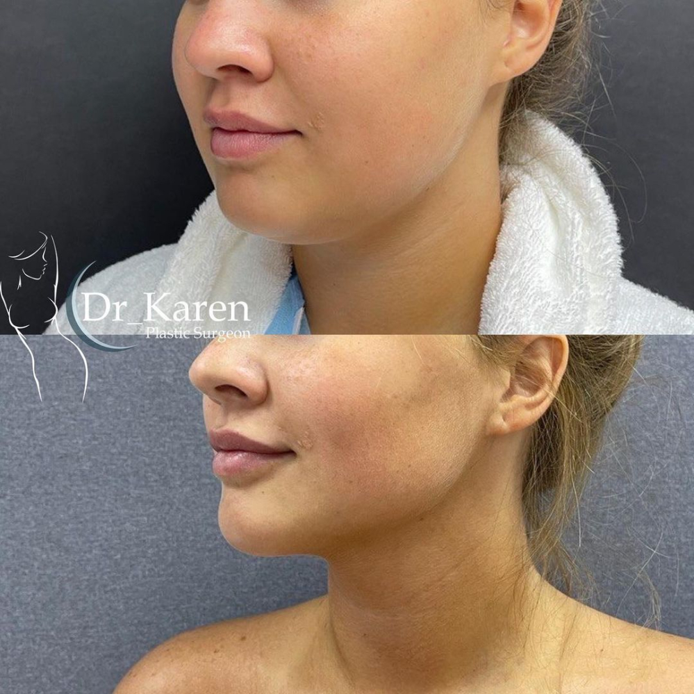 Пациентка доктора Карена Пайтяна до и после липомоделирования подбородка и удаления комков Биша