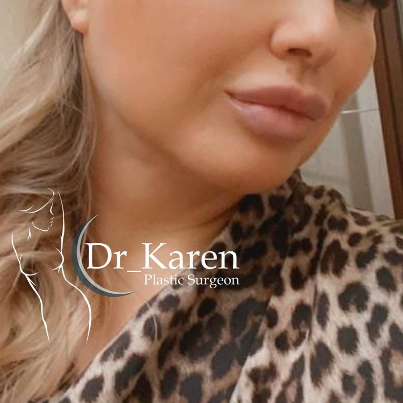 Пациентка доктора Карена Пайтяна до и после липомоделирования подбородка