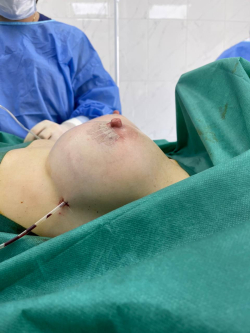 Пациентка доктора Карена Пайтяна после увеличения груди с применением технологии “Dual-plane”