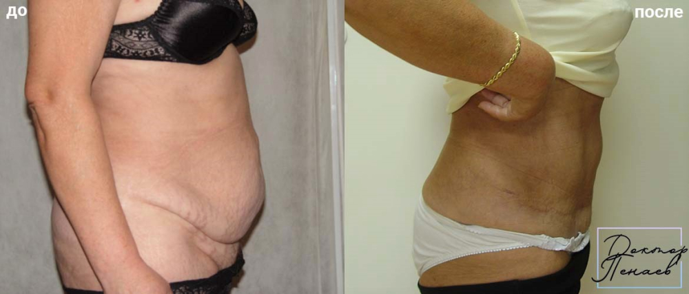 Пациентка пластического хирурга Арслана Пенаева после липоабдоминопластики