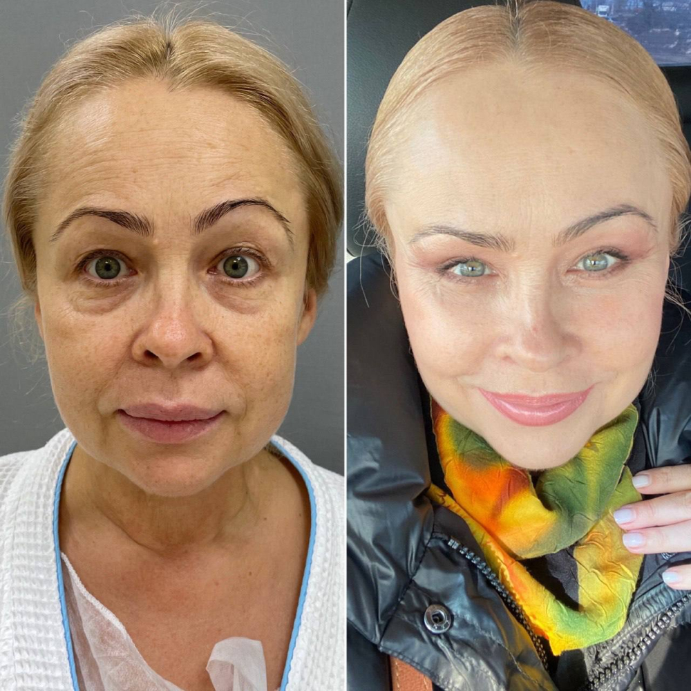 Пациентка пластического хирурга Марины Четвериковой до и после омоложения лица