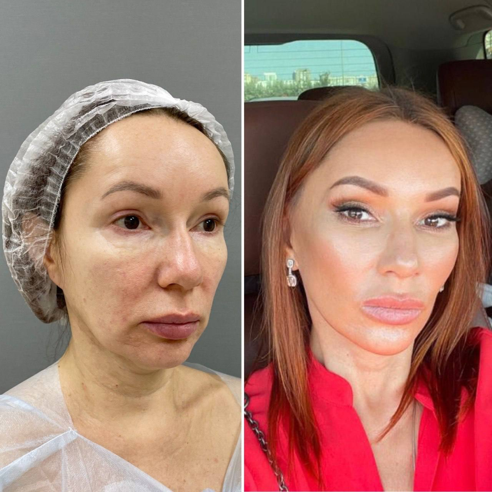 Пациентка пластического хирурга Марины Четвериковой до и после комплексного омоложения лица