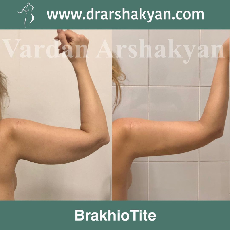 Пациентка пластического хирурга Вардана Аршакяна до и после безразрезной подтяжки рук Брахиотайт