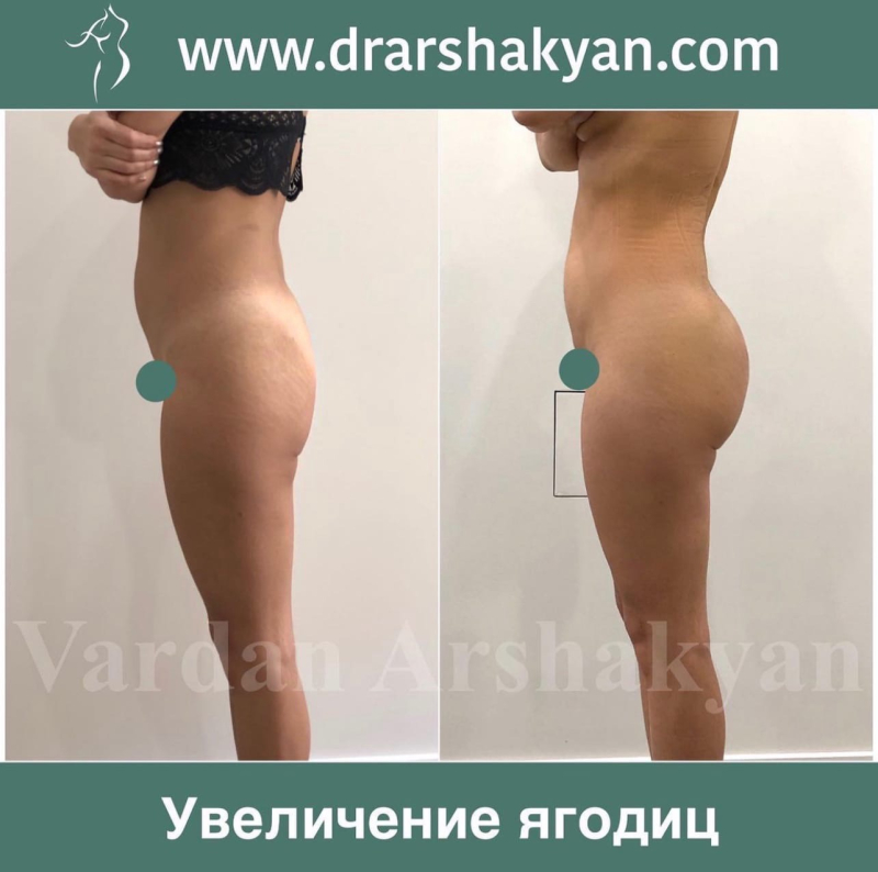 Пациентка пластического хирурга Вардана Аршакяна до и после радиочастотного скульптурирования тела Боди Тайт в Москве