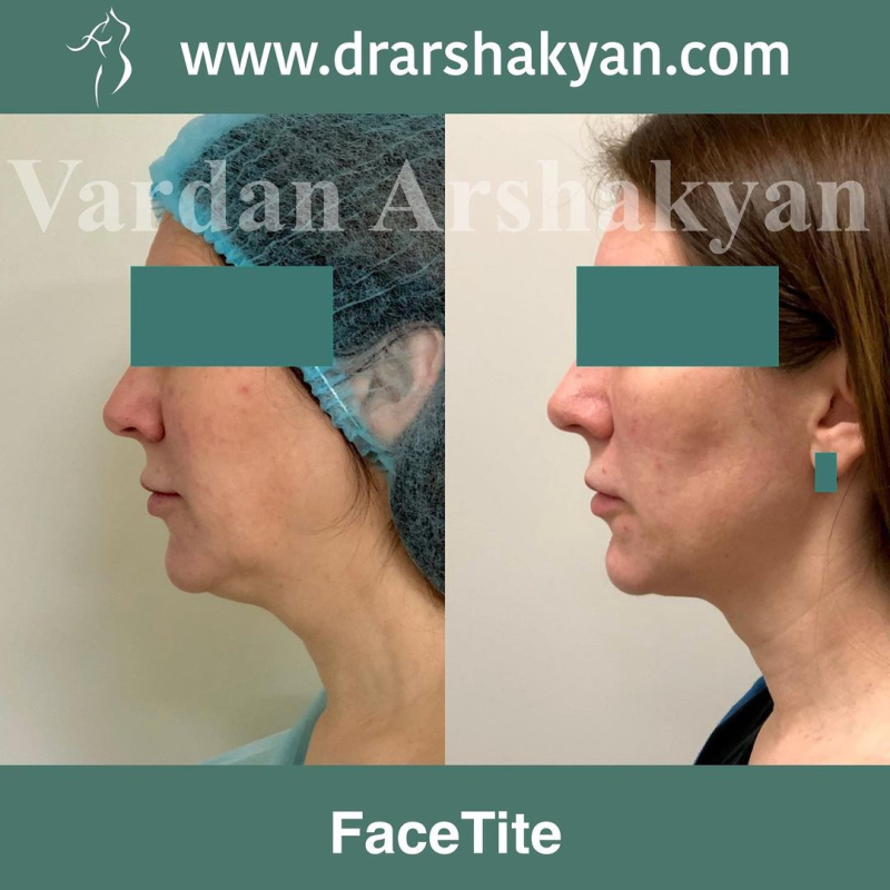 Пациентка пластического хирурга Вардана Аршакяна до и после подтяжки лица ФейсТайт