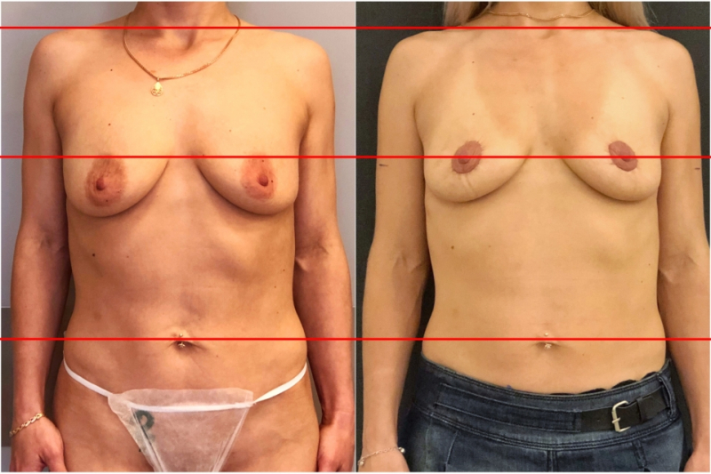 Пациентка пластического хирурга Вардана Аршакяна до и после безразрезной подтяжки груди Брестайт