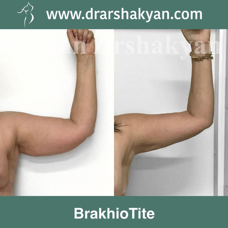 Пациентка пластического хирурга Вардана Аршакяна до и после безразрезной подтяжки рук Брахиотайт в Москве