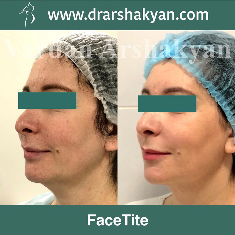 Пациентка пластического хирурга Вардана Аршакяна до и после подтяжки лица ФейсТайт в Москве