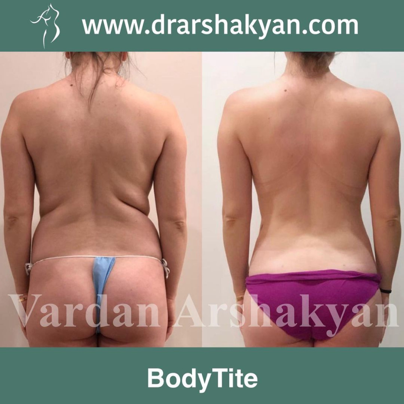 Пациентка пластического хирурга Вардана Аршакяна до и после радиочастотного скульптурирования тела Боди Тайт