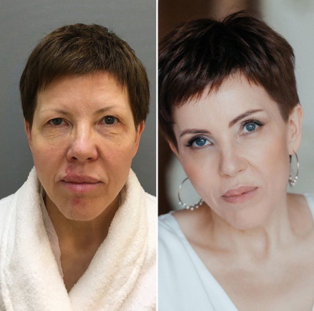 Пациентка пластического хирурга Марины Четвериковой после комплексной подтяжки лица.