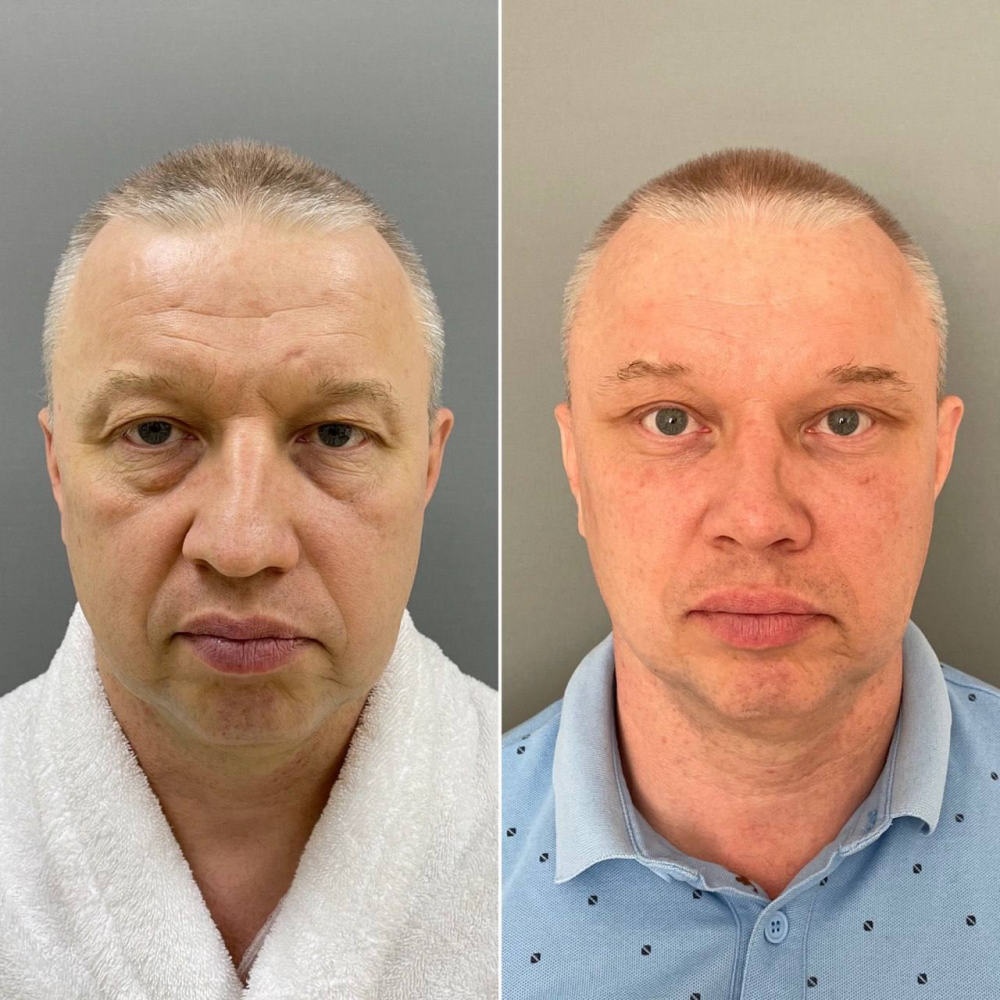 Пациент пластического хирурга Марины Четвериковой до и после омоложения