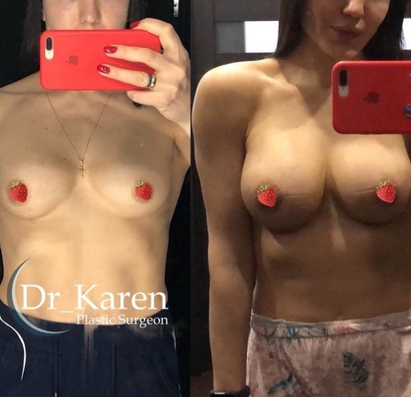 Пациентка пластического хирурга Карена Пайтяна до и после замены грудных имплантатов