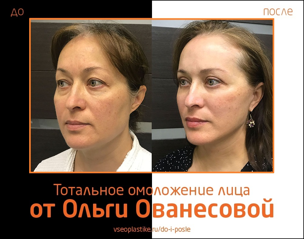 Ольга Ованесова. Фото до и после тотального омоложения лица
