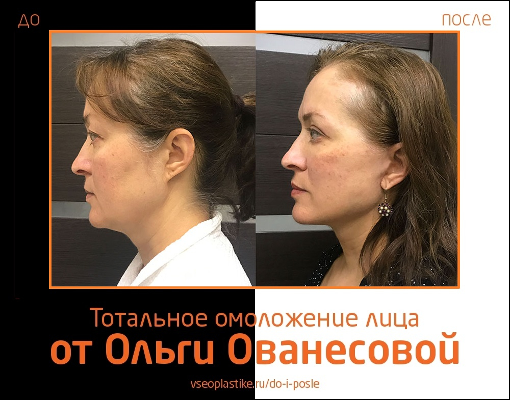 Ольга Ованесова. Фото до и после тотального омоложения лица