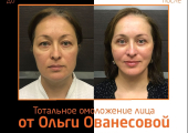 Ольга Ованесова. Фото пациентки до и после тотального омоложения лица в Москве