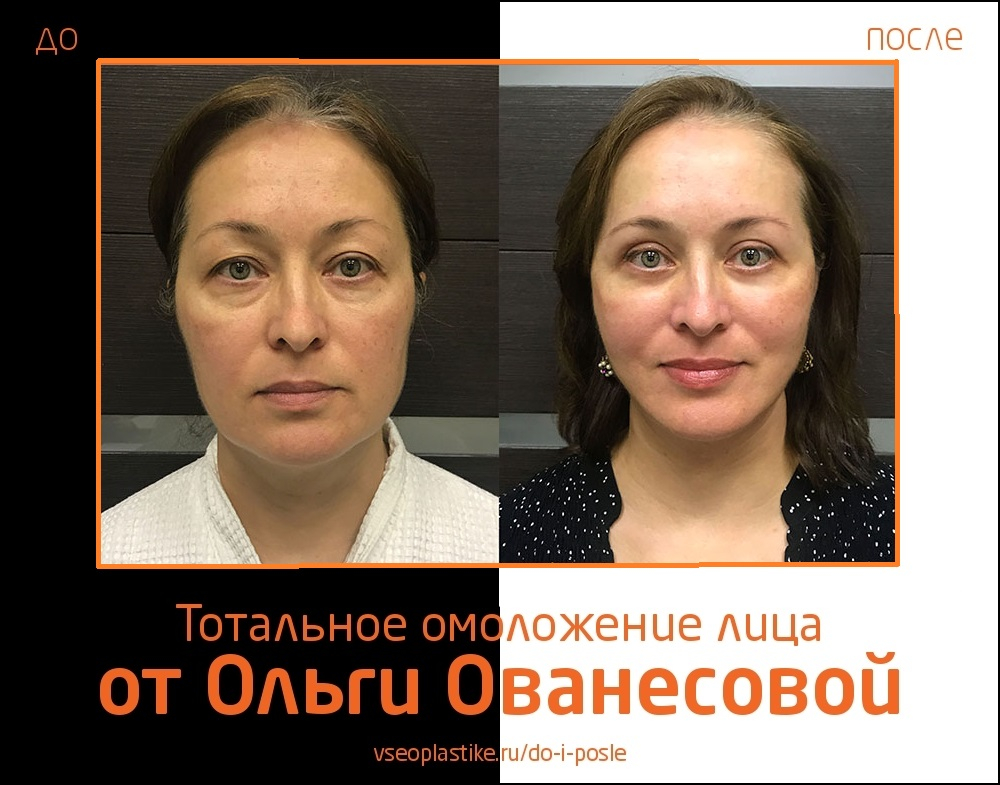 Ольга Ованесова. Фото до и после тотального омоложения лица