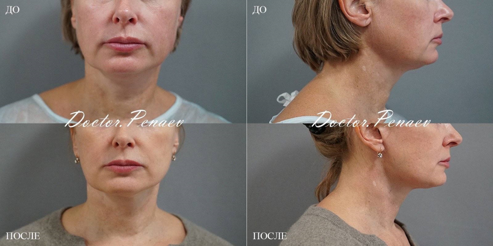 Пациентка пластического хирурга Арслана Пенаева до и после подтяжки лица.