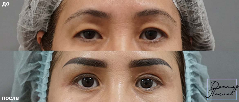 Пациентка пластического хирурга Арслана Пенаева до и после пластики восточных век
