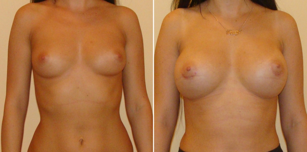 Пациентка доктора Дмитрия Рябцева до и после увеличения груди