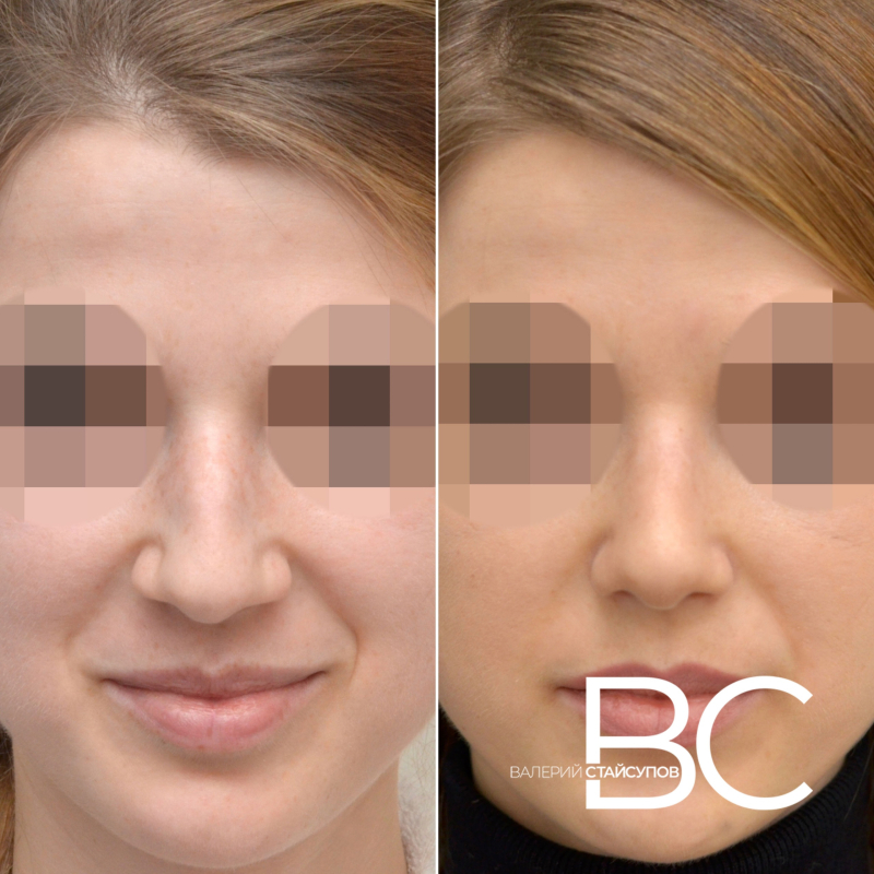 Пациентка пластического хирурга Валерия Стайсупова до и после закрытой септоринопластики