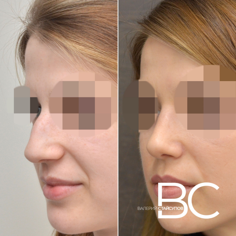 Пациентка пластического хирурга Валерия Стайсупова до и после закрытой септоринопластики.