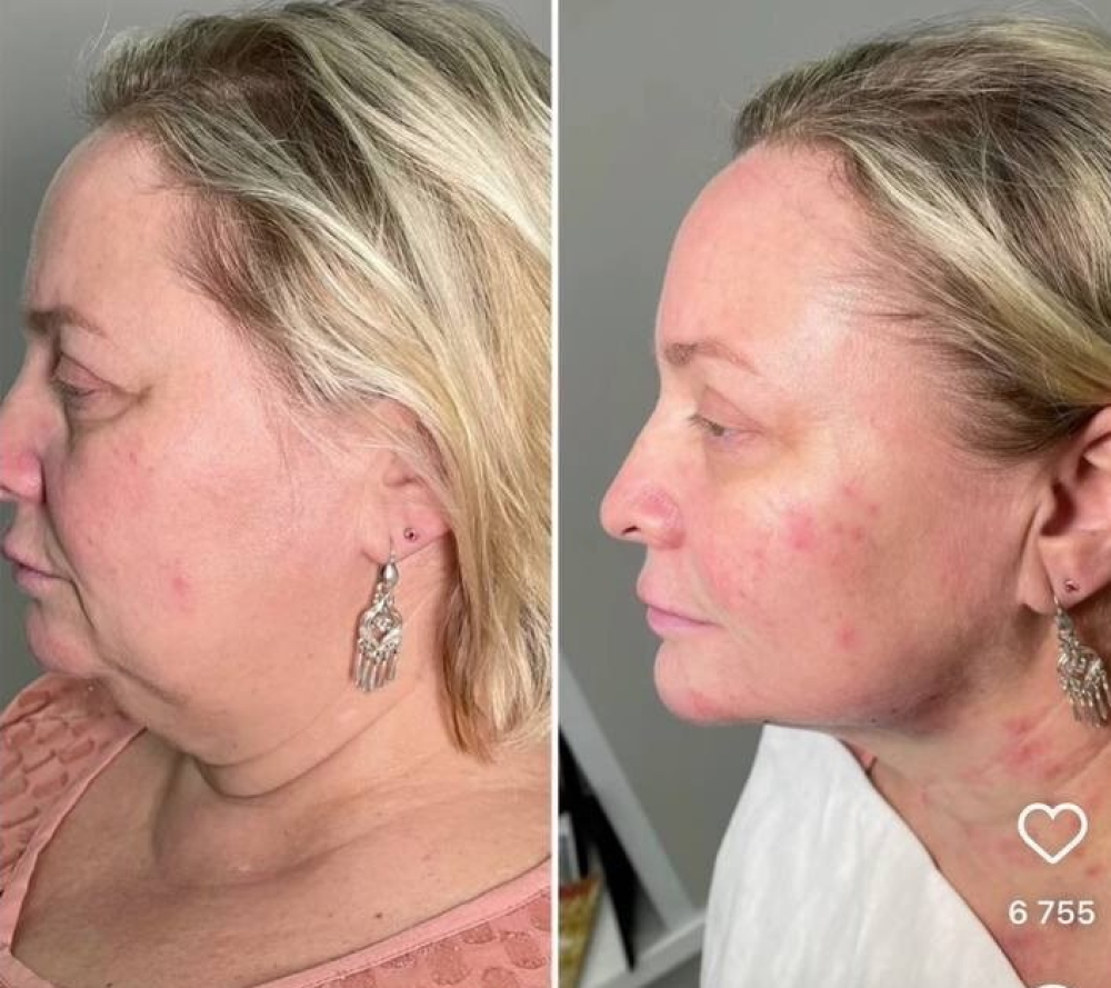 Актриса Светлана Пермякова  сделала омоложение лица