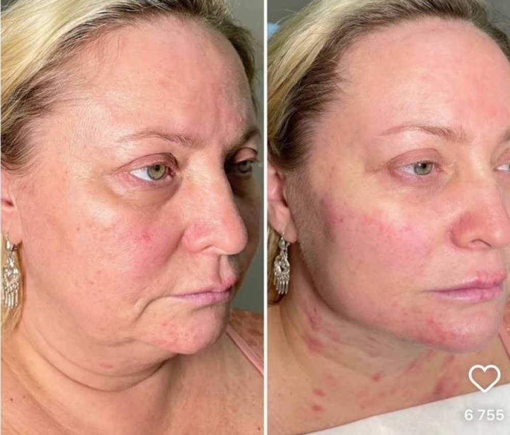 Светлана Пермякова  сделала омоложение лица