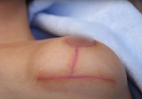 Чего ожидать от шрамов после подтяжки груди