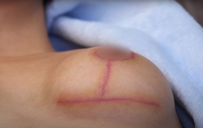 Чего ожидать от шрамов после подтяжки груди