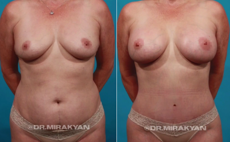 Пациентка пластического хирурга Гукаса Миракяна. Фото до и после пластики живота