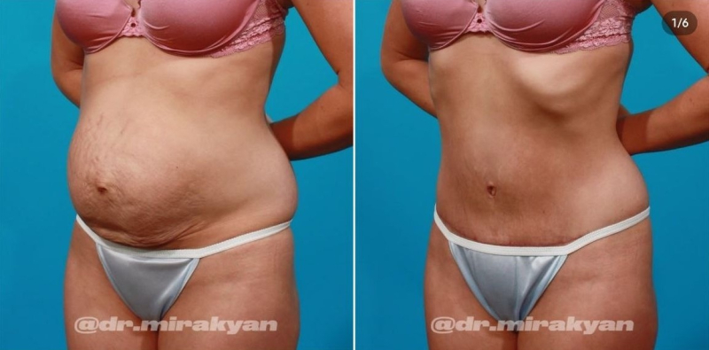 Пациентка пластического хирурга Гукаса Миракяна. Фото до и после пластики живота в Москве