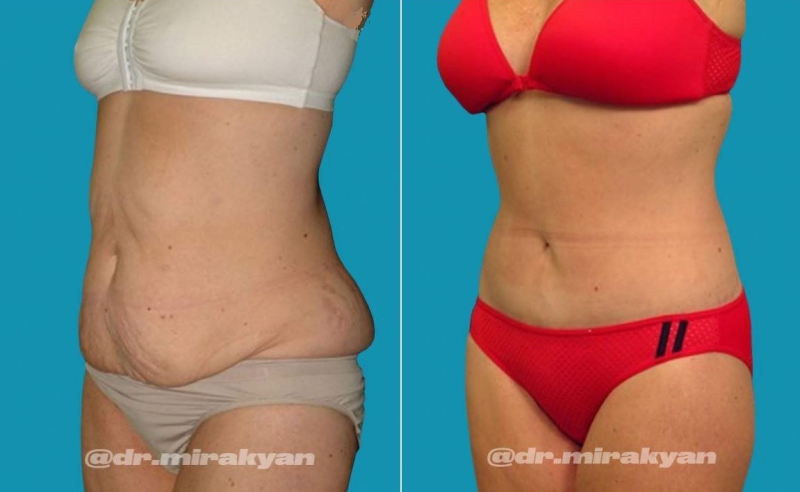 Пациентка пластического хирурга Гукаса Миракяна. Фото до и после операции по пластике живота в Москве