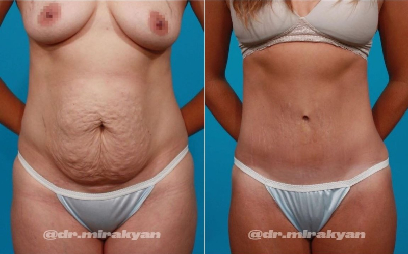 Пациентка пластического хирурга Гукаса Миракяна. Фото до и после операции по подтяжке живота в Москве