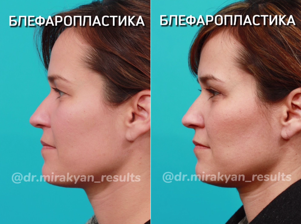 Пациентка пластического хирурга Гукаса Миракяна до и после пластики век