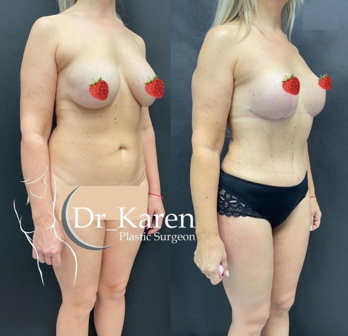 Пациентка пластического хирурга Карена Пайтяна до и после комплексной операции по проекту Постнатал.