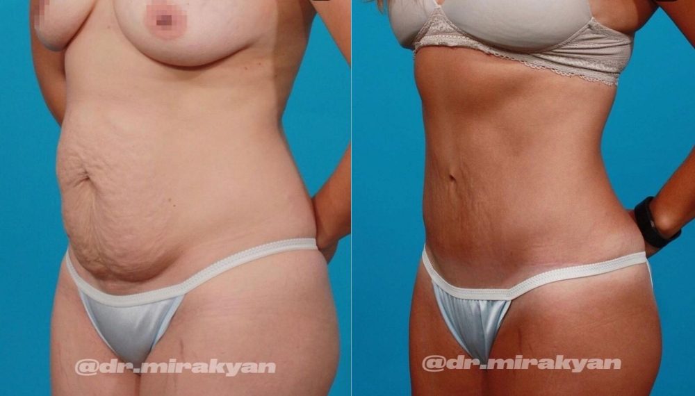 Пациентка пластического хирурга Гукаса Миракяна. Фото до и после абдоминопластики и липосакции спины
