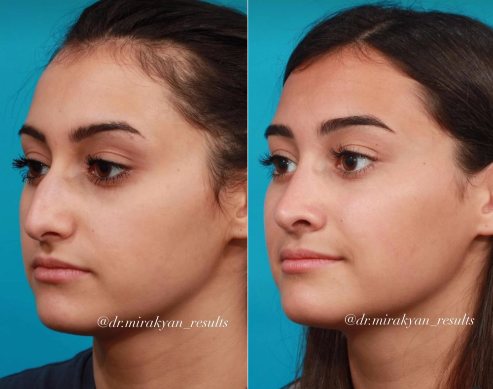 Пациентка пластического хирурга Гукаса Миракяна. Фото до и после ринопластики