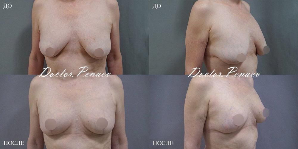 Пациентка (51 год)  пластического хирурга Арслана Пенаева до и после подтяжки груди