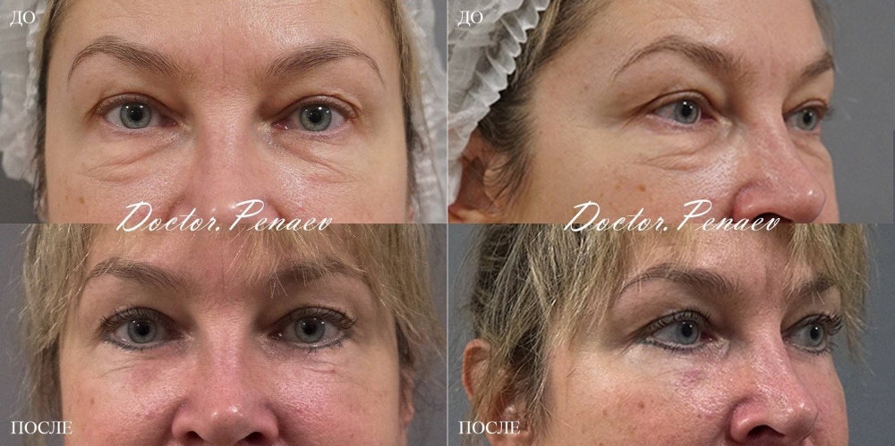 Пациентка до и после круговой блефаропластики у пластического хирурга Арслана Пенаева