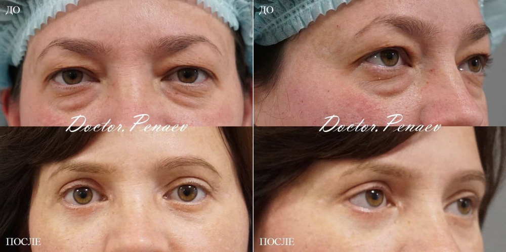 Пациентка до и после круговой блефаропластики у пластического хирурга Арслана Пенаева в Москве