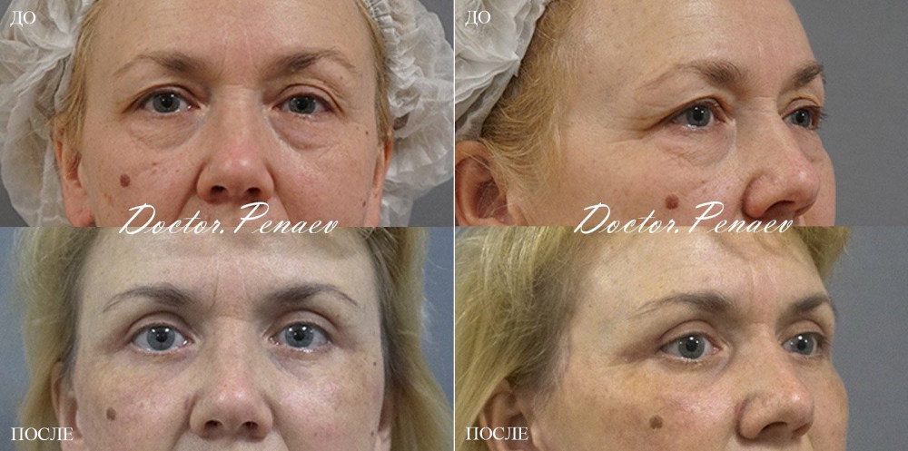 Пациентка до и после круговой блефаропластики у хирурга Арслана Пенаева в Москве